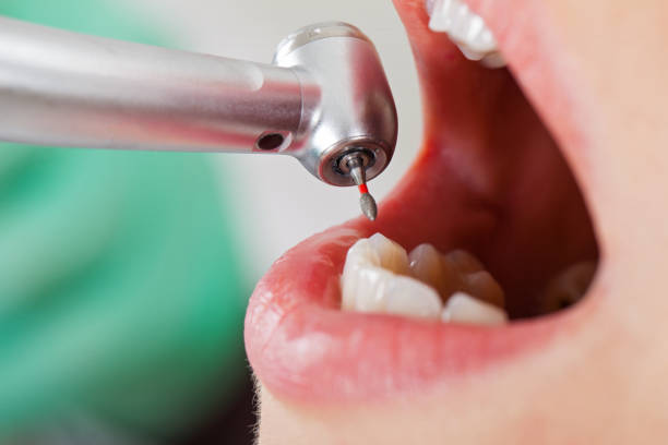 Urgent Tooth Repair in DE